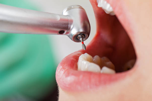 Best Emergency Dentist for Lost Fillings or Crowns in Dorneyville, PA